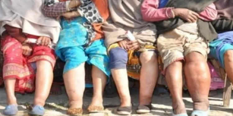 दाङमा भेटिए हात्तीपाइलेका बिरामी